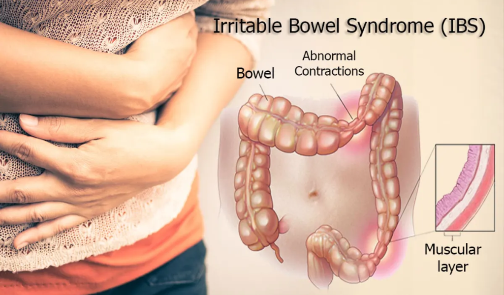 CBD's Potential Benefits for Irritable Bowel Syndrome (IBS)